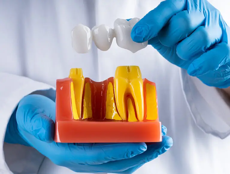 Implant Supported Bridges